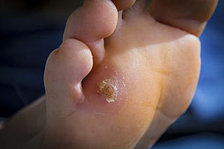 When to Seek Professional Help for Foot Calluses: Signs You Shouldn’t Ignore
