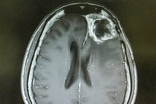 Detecting Brain Tumours using QNNs