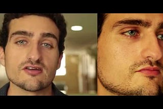 Tips to Change Your Eye Color Permanently Through Iris Implant Surgery