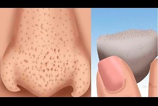 Eliminate blackheads in just 3 minutes by doing this — YouTube