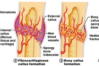 Improving Bone Fracture Recovery via A Nanofibrous Scaffold