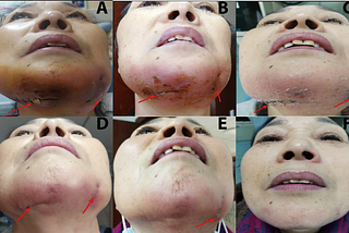 Elizabethkingia Anopheles Infection after Hyaluronic Acid Injection: A Case Report and Review