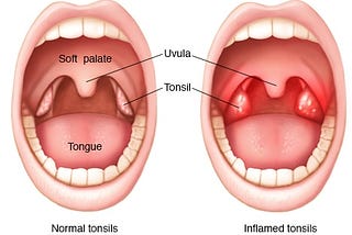 Tonsillectomy