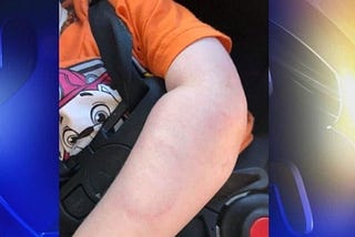 Menino de 11 meses é mordido no braço por funcionária de creche