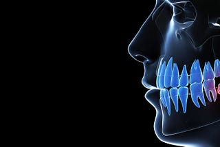 wisdom tooth extraction