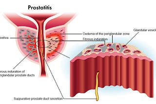Symptoms of UTI and the ones suffering with enlarged prostate