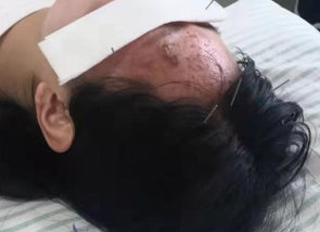 Successful Treatment of Herpetic Itch with Traditional Chinese Acupuncture and Cotton-Moxibustion…