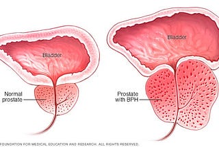 Rezum as a way to address Benign Prostatic Hyperplasia