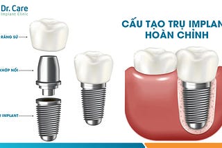 Trồng răng bằng cấy ghép Implant có thật sự tốt