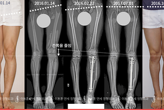 Limb Lengthening Treatment