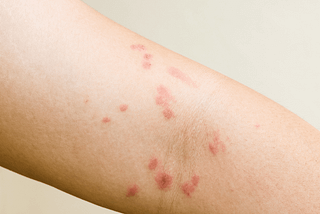 What is Dermatitis Herpetiformis?