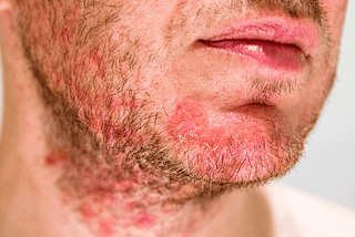 What is Seborrheic Dermatitis?