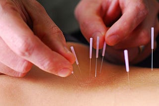 Whаt іѕ dіffеrеnсе between IMS аnd Acupuncture