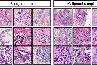 Classifying Malignant and Benign Breast Tumours with a Neural Network