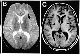 Long Measles: It’s like Long Covid, But Deadlier.
