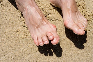 Correcting a Hammer Toe: Treatment Options and Prevention Tips