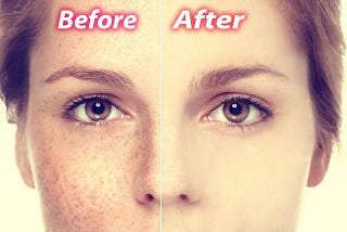 Get Rid of Freckles Naturally and Fast Overnight Permanently