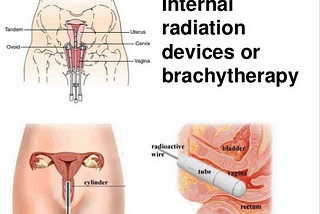 Radiation Therapy for Cervical Cancer