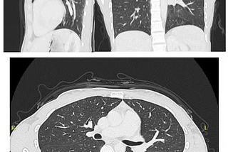 Primary Pulmonary Angiosarcoma in 25-Year Old Patient