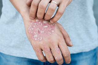 What is eczema? How to get rid of eczema? Types, Causes and Treatment