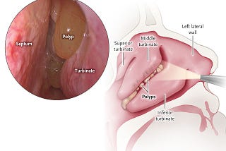 Nasal Polyps Case Study and How To Treat It