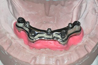 Implant-anchored Dentures Provide a Secure Smile