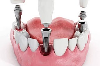 The Role of Bone Density in Dental Implant Success