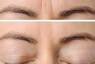 Erase the years. Effective treatments for glabellar lines