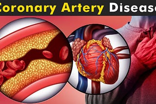 Coronary Heart Disease Overview — Symptoms — Treatment #1
