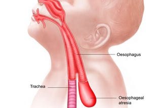 Esophageal Atresia and Me