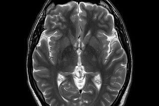 Sanavo: Ending the Death Sentence of Glioblastoma (Brain Canc