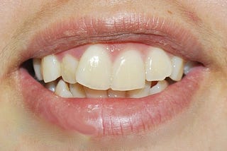 Cách khắc phục răng bị vẩu hiệu quả an toàn
