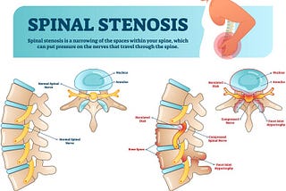 Spinal Stenosis: Symptoms, Treatment, Outlook