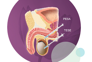 Sperm retrieval — PESA & TESA