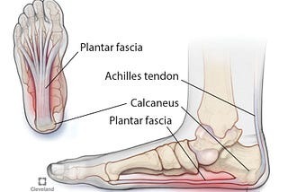 Plantar Fasciitis, Flat Feet