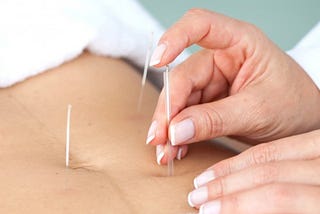 Tratamento Natural com Acupunctura