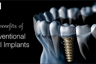 Top Benefits Of Conventional Dental Implants- Dr Jatinder Sharma DDS