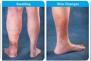 What are varicose veins?