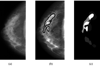 Breast Cancer Detection with KNN Algorithm