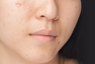 How Does Rejuvenating Set Treat Dark Spots?