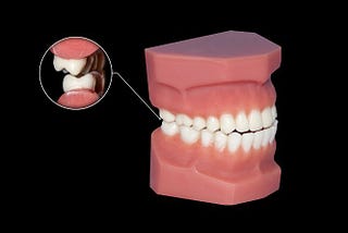 Are Dental Implants An Option If I Grind My Teeth?