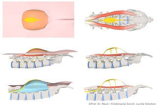 Interactive 3D Models of the Spina bifida