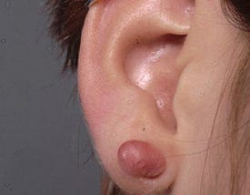 keloid on ear where ear piercing was