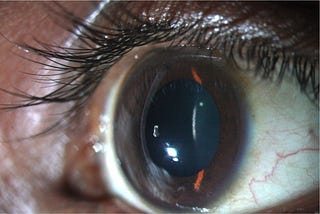 How I trained a LSTM for diagnosing a corneal disease.