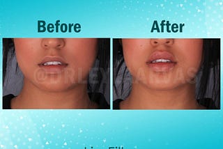 Lip Filler: Most Wanted Cosmetic Procedure