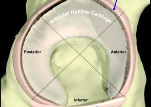 Hip Labral Tear Recovery Without Surgery