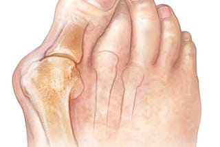 Foot Freedom Awaits: Discover the Ultimate Bunion Prevention and Treatment Solutions