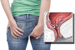 List obat salep ambeien paling ampuh di apotik