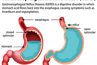 Gastrointestinal Disease