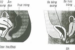 An toàn, tiết kiệm, hiệu quả khi điều trị sa tử cung